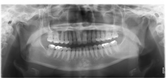 歯周病の進行度合いの検査