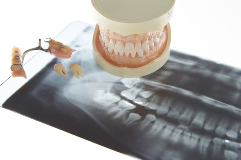 歯を失ってしまった方へ